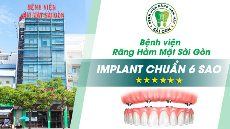 Trồng răng Implant ở đâu tốt TPHCM? – Bệnh viện Răng Hàm Mặt Sài Gòn
