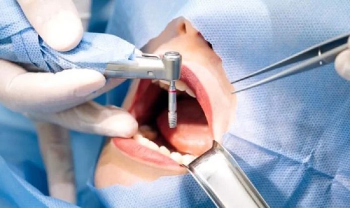 Top 10 địa chỉ trồng răng Implant tốt nhất tại TPHCM