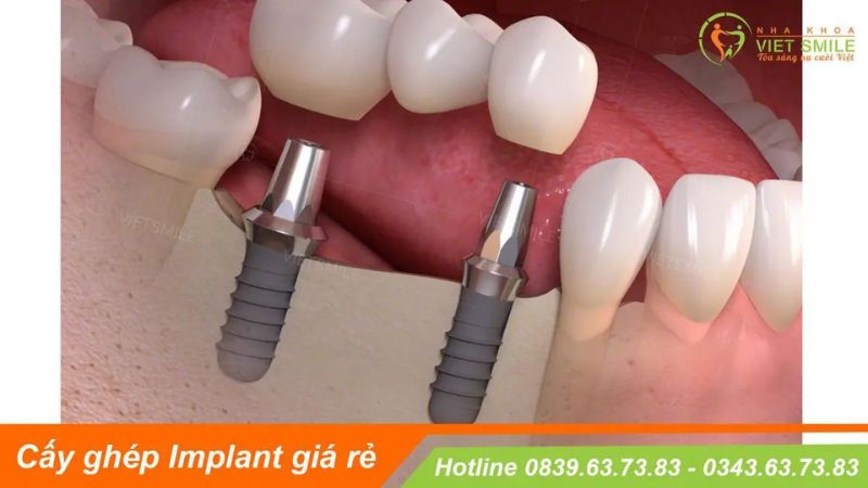 Nha khoa VIET SMILE - Địa chỉ trồng răng implant uy tín