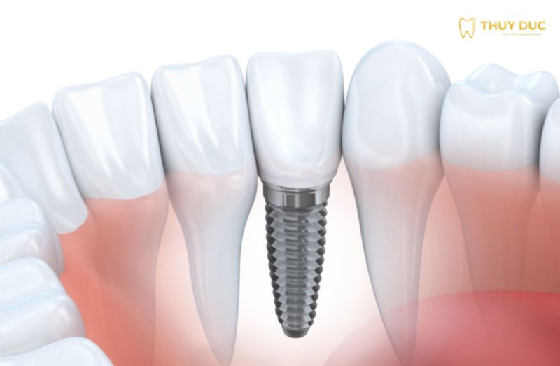 Nha khoa Thuý Đức - Trồng răng implant nguyên hàm uy tín