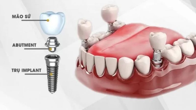 Nha khoa Shinbi - Địa chỉ trồng răng Implant tốt nhất
