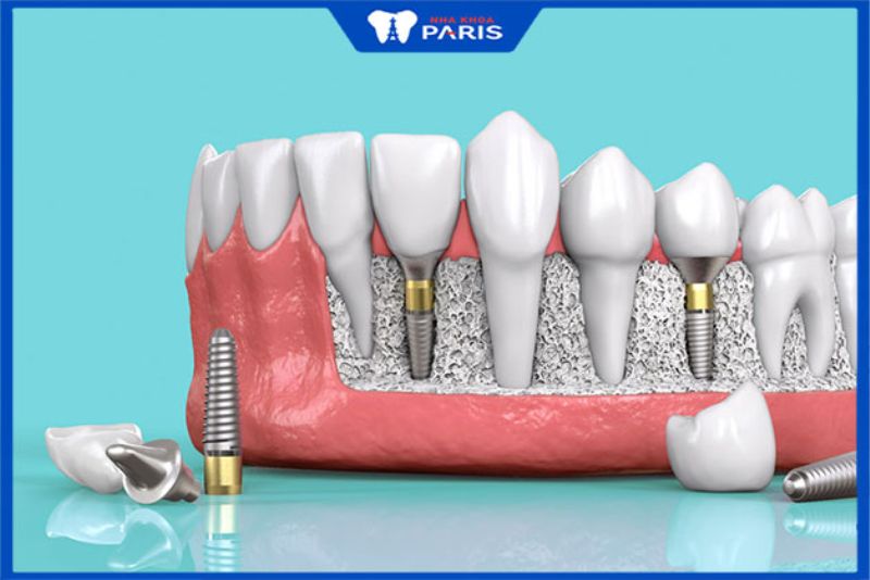 Nha khoa Paris - Nơi trồng răng Implant tốt ở Hà Nội