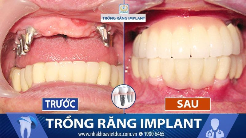 Nha khoa Việt Đức - Trồng răng Implant tốt nhất Hà Nội