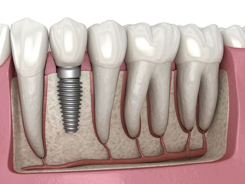 Nha khoa Sunshine Dental Clinic - Địa chỉ trồng răng Implant thành công cao